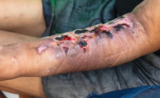 مخدر «زامبی» تهدیدی نوظهور؛ فوت مصرفکنندگان بعد از اوردوز 2 مخدر «زامبی» تهدیدی نوظهور؛ فوت مصرفکنندگان بعد از اوردوز